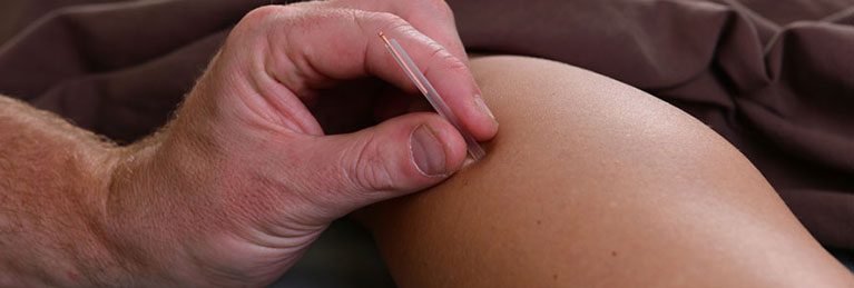 dry needling